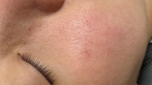 Skin Hydration Before